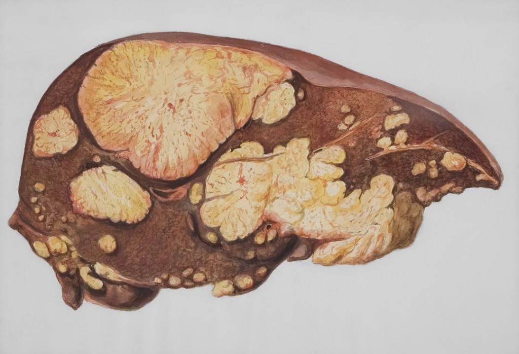 Photo Diabetic Neuropathy Symptoms